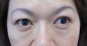 目の下のたるみ、目のくまでお悩みの方、切らずに完璧に解決します。TCB-R法　手術直後　症例写真